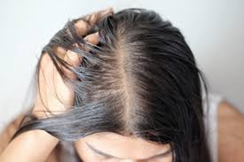 Oily Scalp