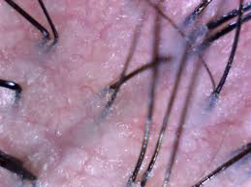 Sensitive Scalp